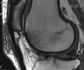 Patella Tendon Tear MRI